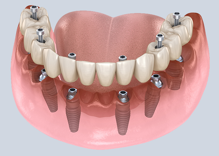 3-on-6 Implants