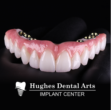 Hybrid Implant Bridge