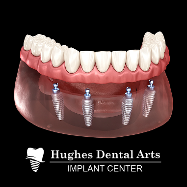Zirconia Implant Bridge
